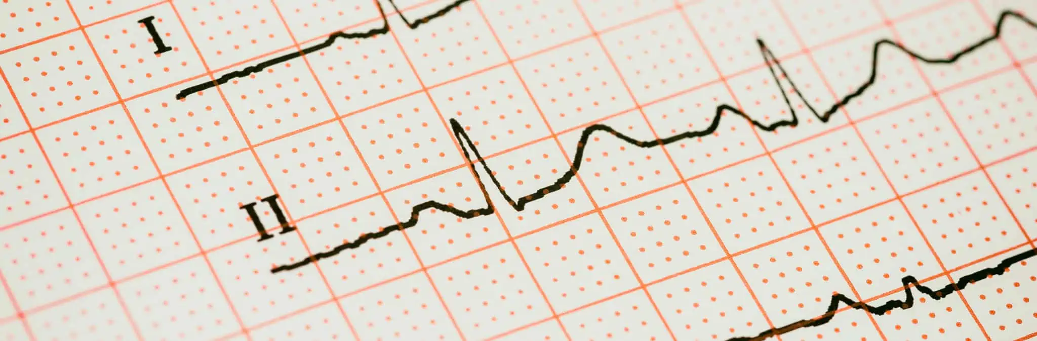 Taxa de esforço: Como calcular e reduzir? eletrocardiograma